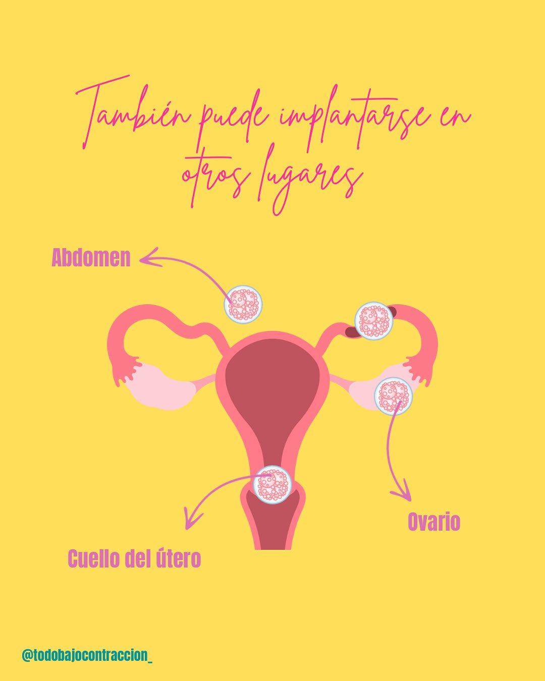 Carrusel ilustrado de Todo Bajo Contracción: Embarazo ectópico