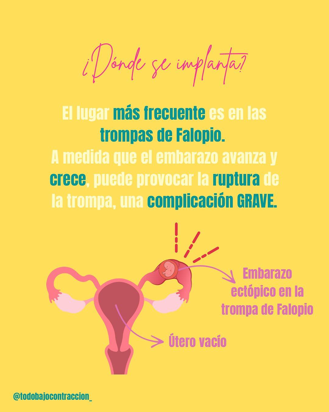 Carrusel ilustrado de Todo Bajo Contracción: Embarazo ectópico