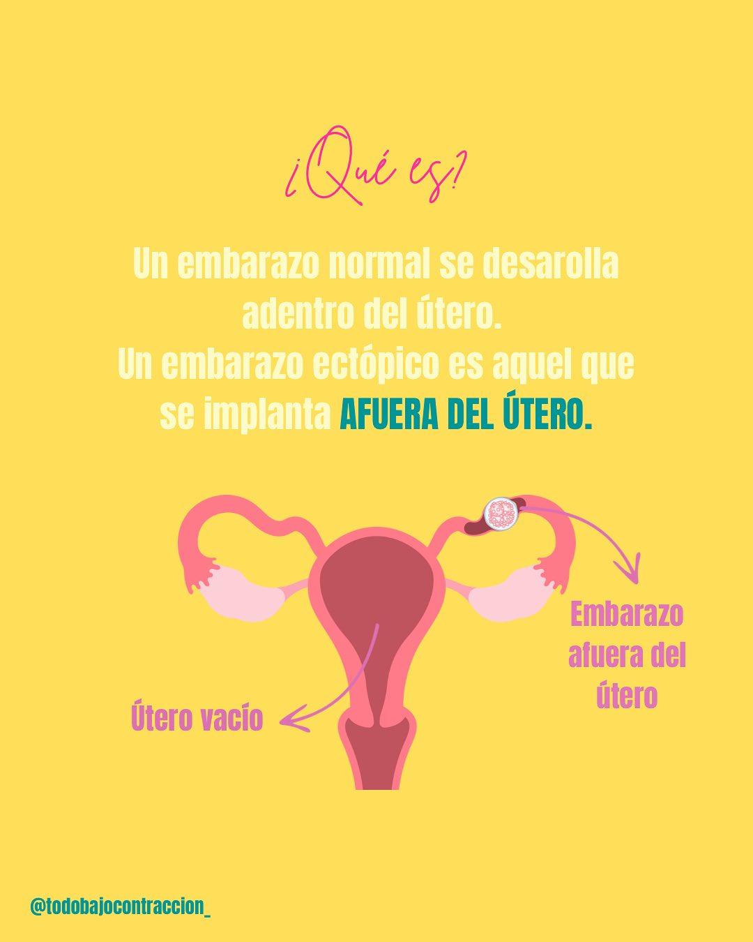 Carrusel ilustrado de Todo Bajo Contracción: Embarazo ectópico