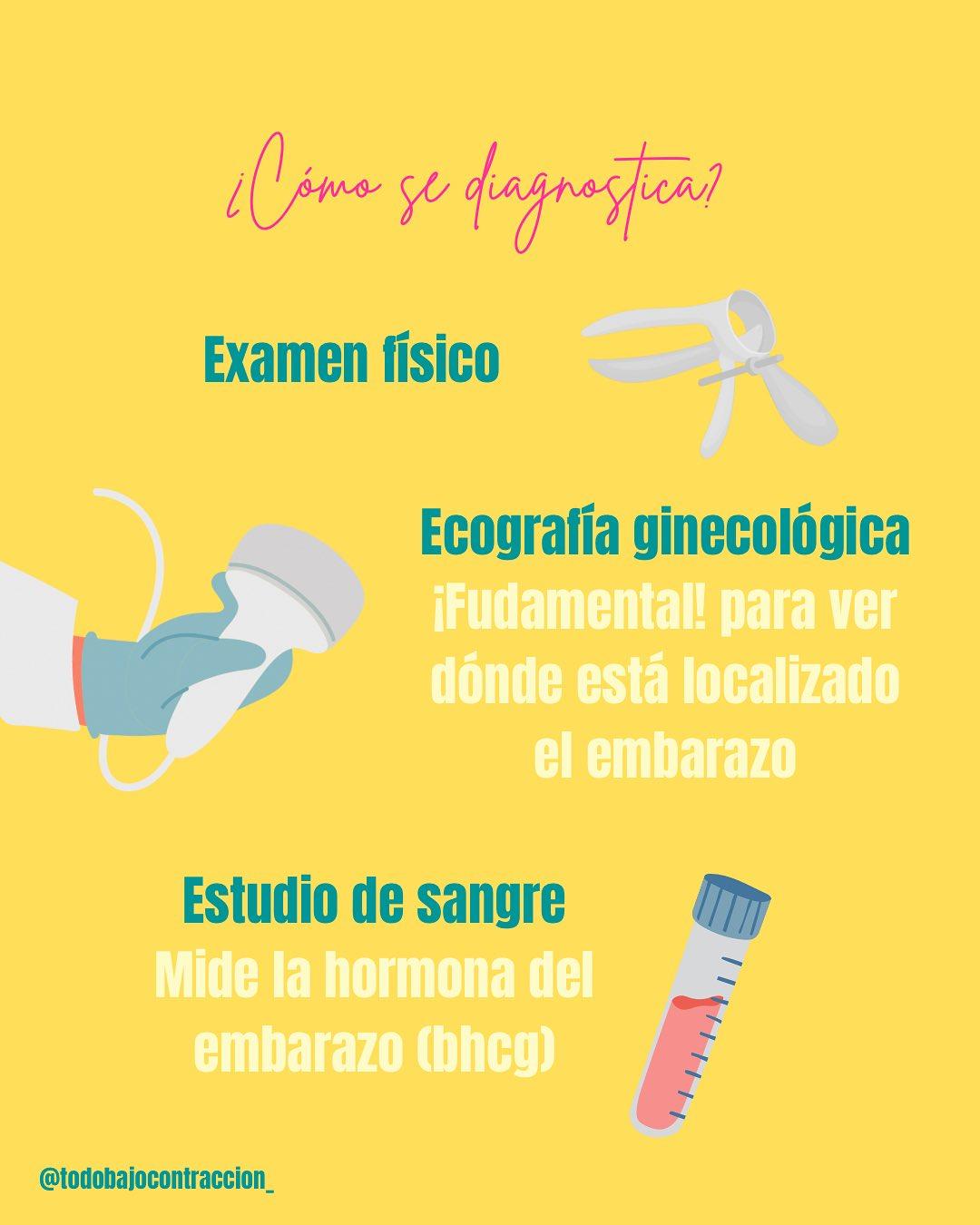 Carrusel ilustrado de Todo Bajo Contracción: Embarazo ectópico