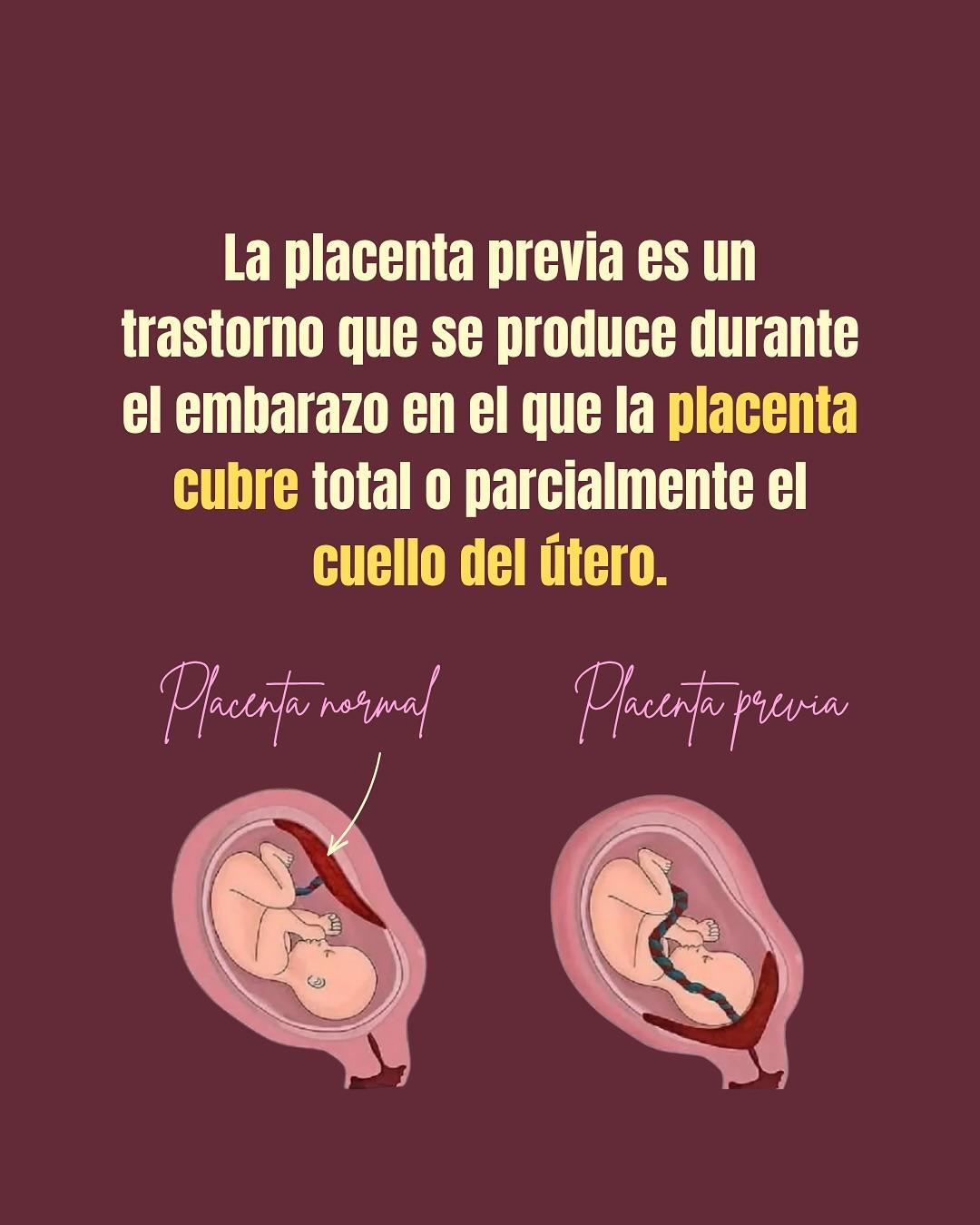Carrusel ilustrado de Todo Bajo Contracción: Placenta previa o baja