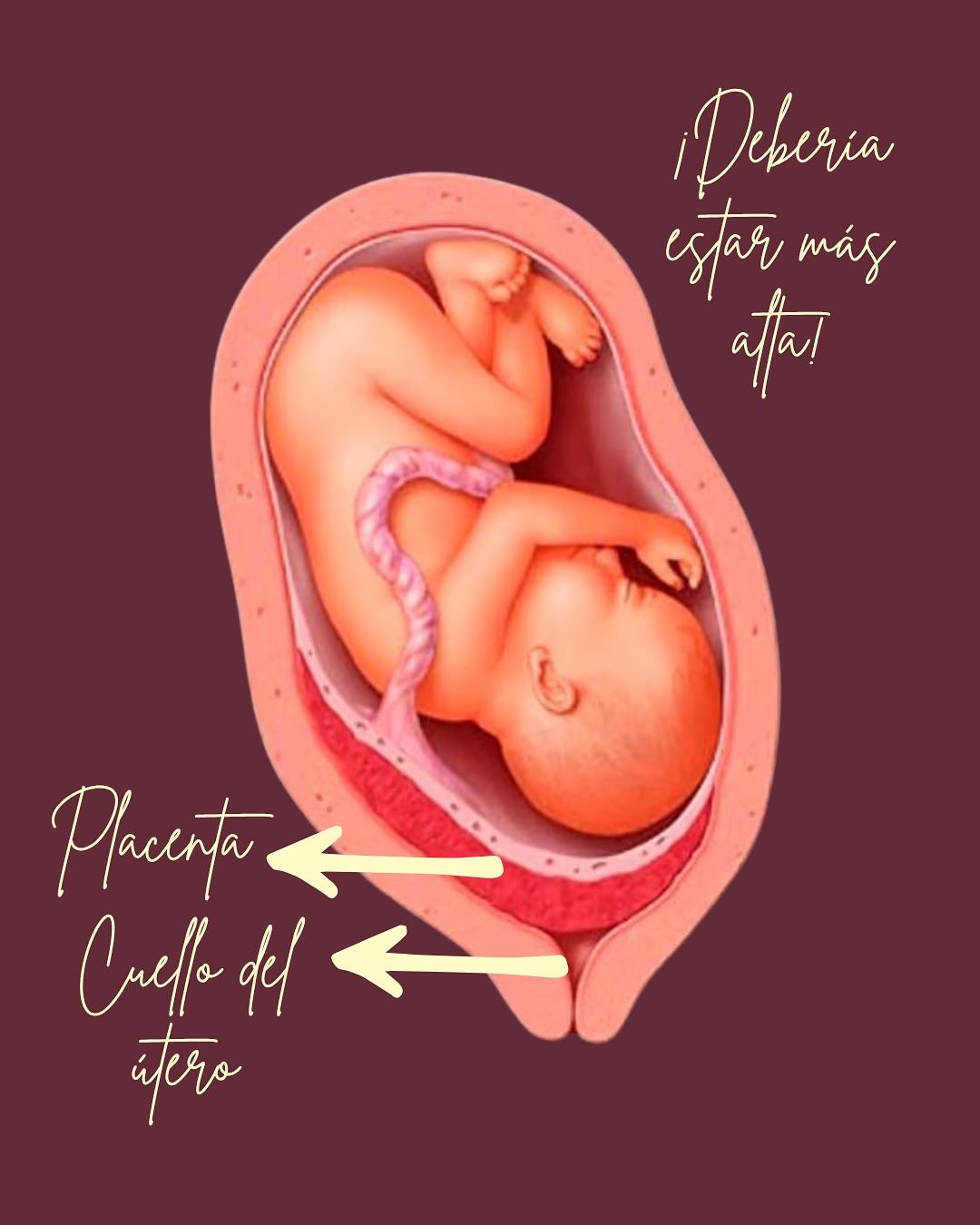 Carrusel ilustrado de Todo Bajo Contracción: Placenta previa o baja