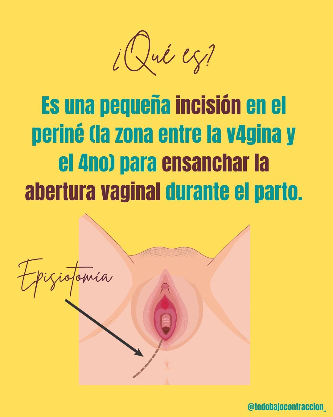 Carrusel ilustrado de Todo Bajo Contracción: Episiotomía: cuándo se hace