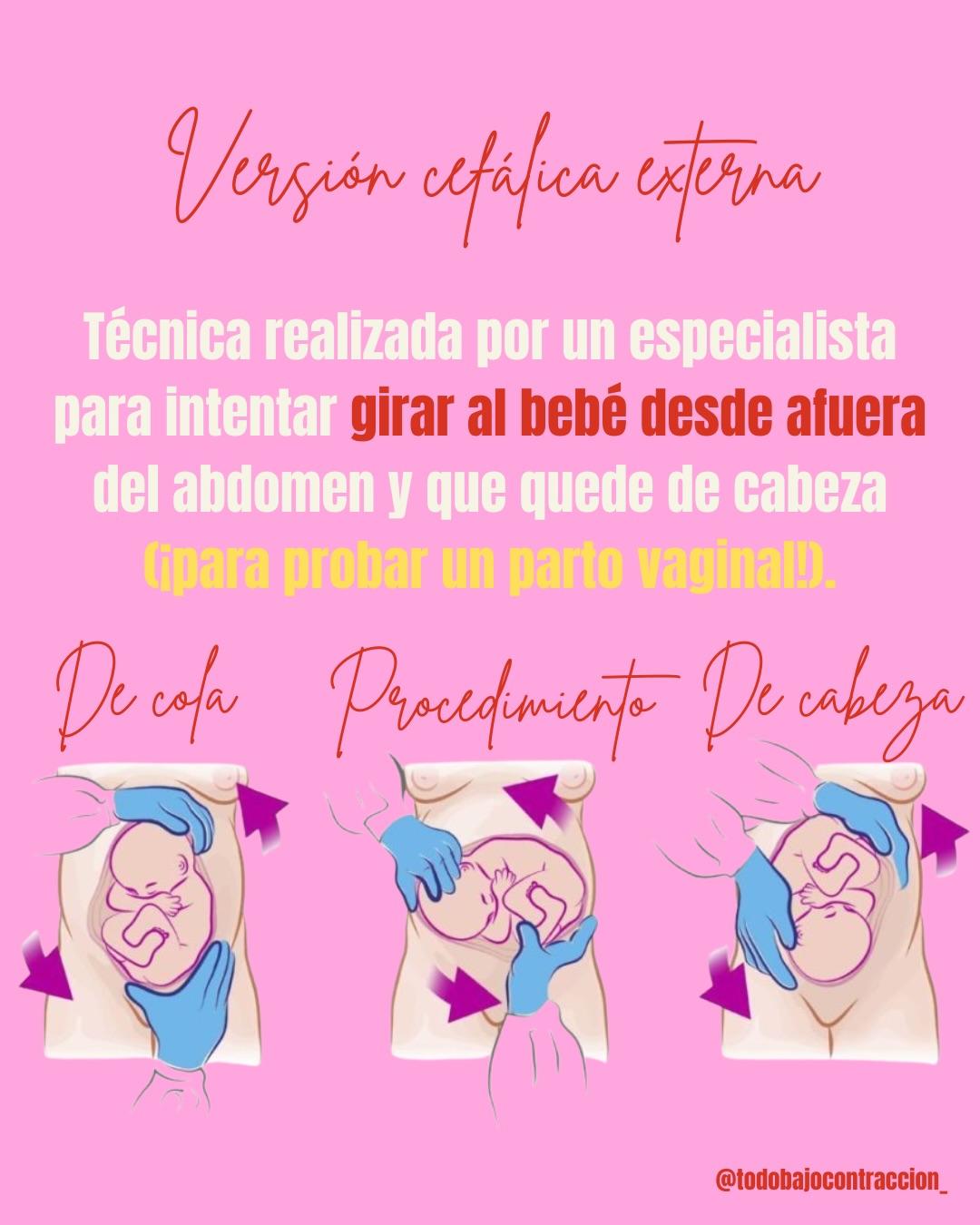 Carrusel ilustrado de Todo Bajo Contracción: Bebé en podálica: ¿siempre cesárea?