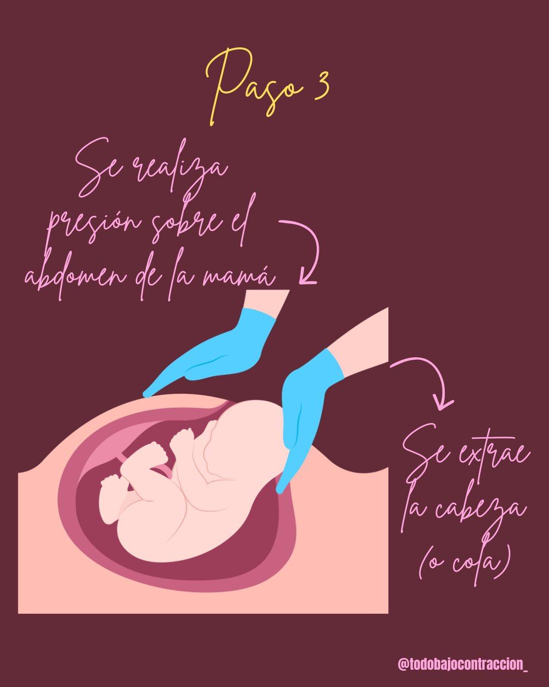 Carrusel ilustrado de Todo Bajo Contracción: Cesárea paso a paso