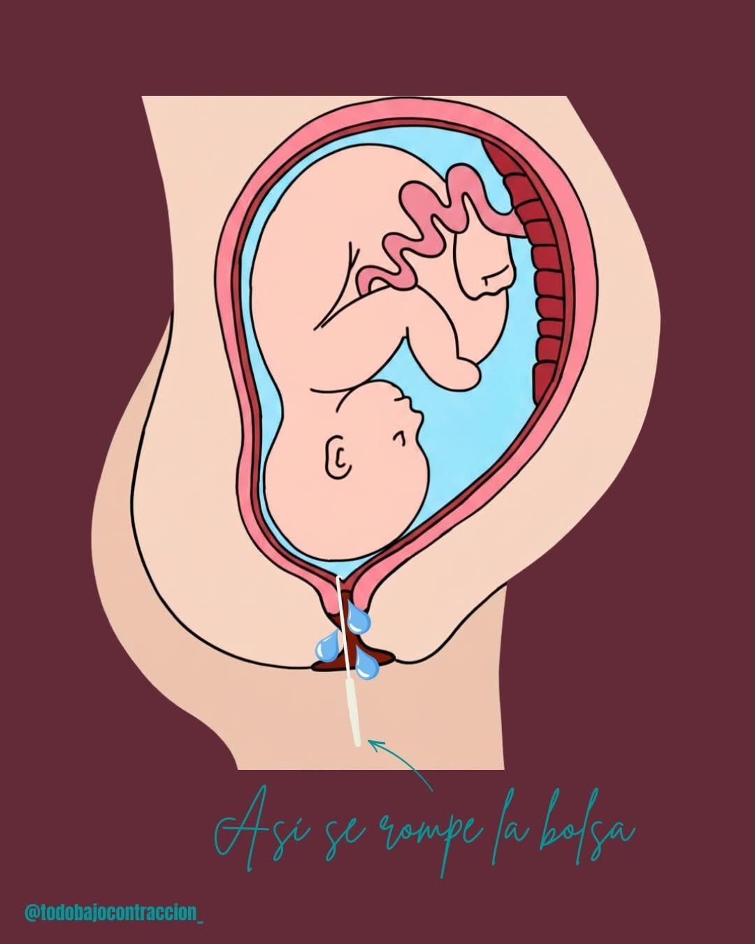Carrusel ilustrado de Todo Bajo Contracción: Inducción del trabajo de parto