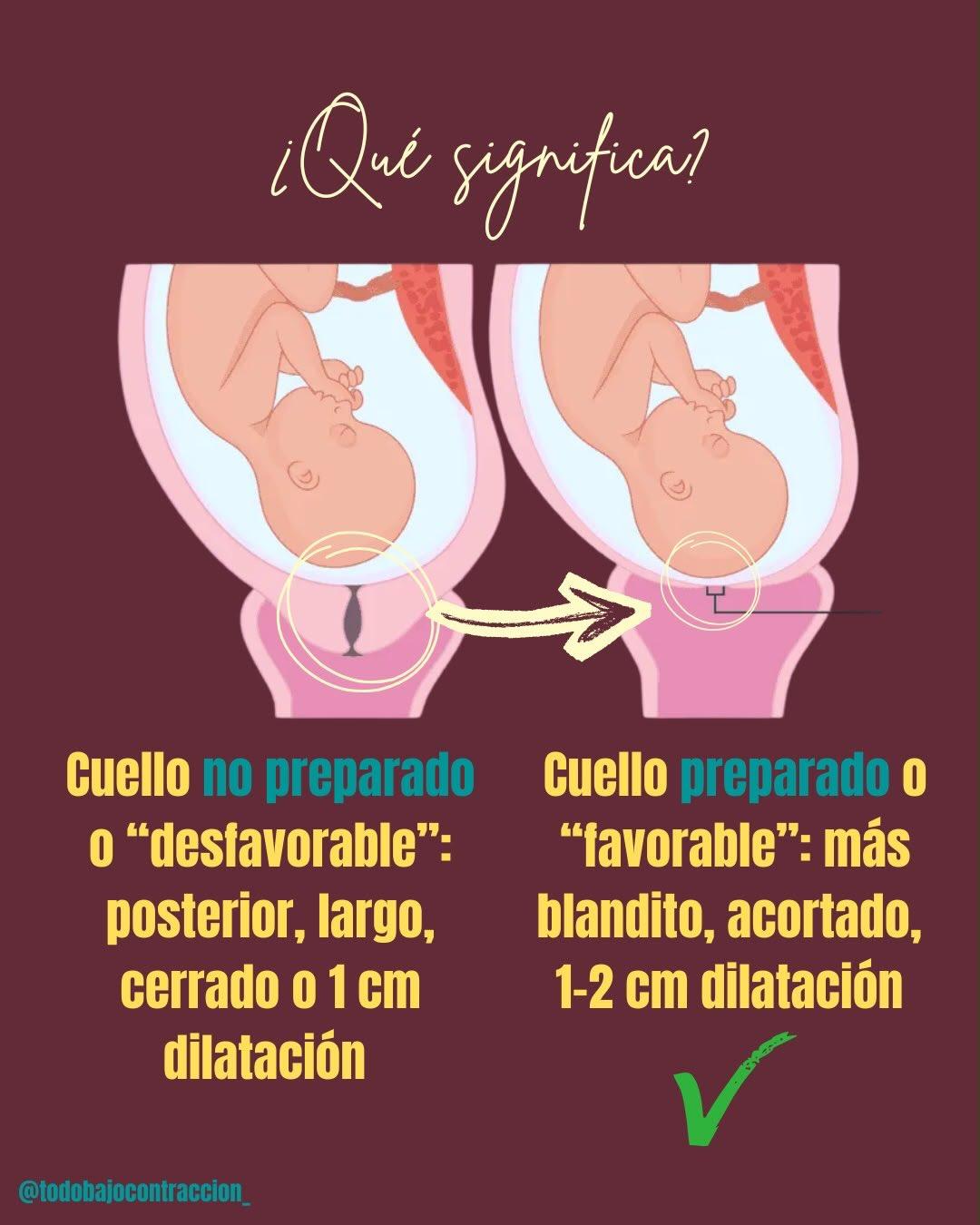 Carrusel ilustrado de Todo Bajo Contracción: Inducción del trabajo de parto